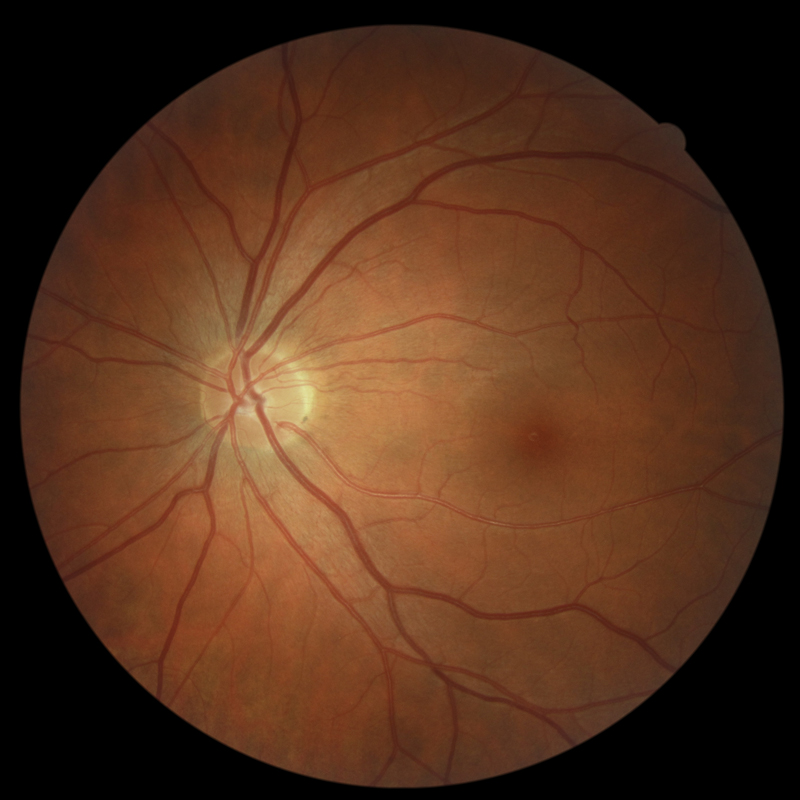 Retinal Image